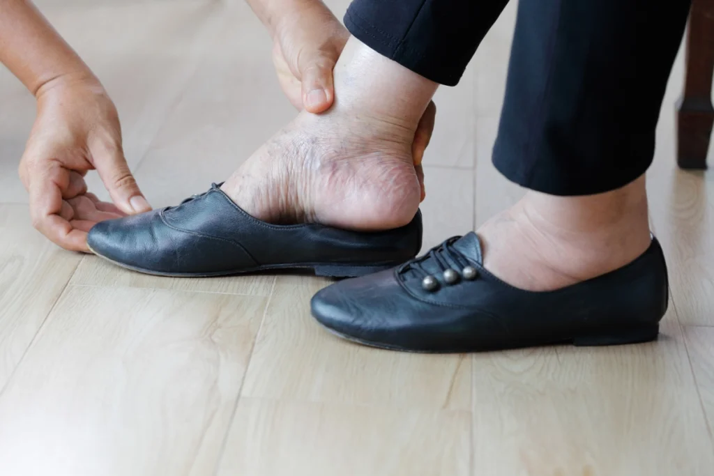 A person with swollen feet